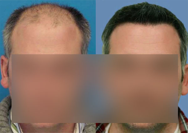 Hair Transplant Results in Ludhiana