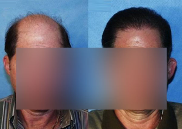 Hair Transplant Results in Ludhiana